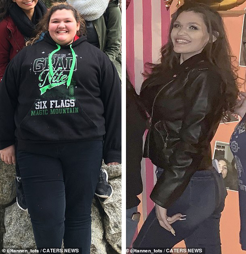 Cô gái 23 tuổi giảm 90 kg nhờ một ca mổ