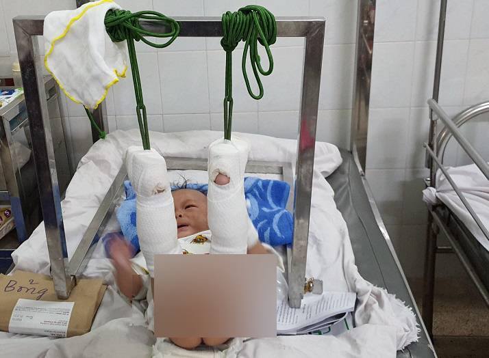 Bé trai 4 tháng tuổi nghi bị bố đánh đến xuất huyết não, gãy chân