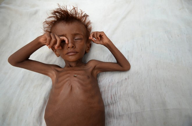 Một trẻ em suy dinh dưỡng tại tỉnh Hodaida, Yemen.  Các cảng biển bị phong tỏa bởi liên quân do Ả Rập Xê Út dẫn đầu, vốn ủng hộ chính phủ Yemen, dẫn đến tình trạng thực phẩm không thể vào được trong nước. 28 triệu dân của đất nước Trung Đông này đang bị nạn đói đe dọa. Ảnh: 