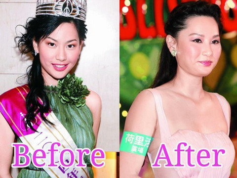 Giai nhân Trung Quốc mặt biến dạng khi tiêm botox quá đà