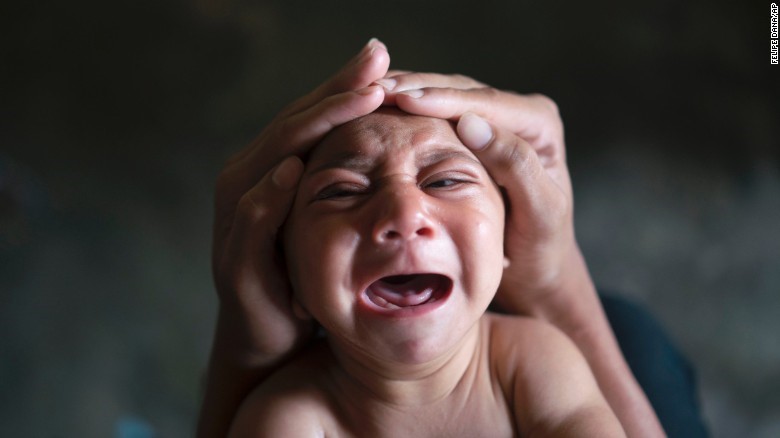 Cậu bé Jose Wesley (đến từ Bonito, Brazil) chào đời với chiếc đầu teo nhỏ (microcephaly). Chứng bệnh này khiến trẻ sinh ra có phần não phát triển lệch lạc hoặc không phát triển dẫn đến khuyết tật về trí tuệ, vận động và ngôn ngữ. Giới chức Brazil tin rằng virus Zika được truyền bởi muỗi vằn là nguyên nhân gây ra dị tật. Vào ngày 1/2, Tổ chức Y tế thế giới (WHO) ban bố tình trạng khẩn cấp y tế công cộng quốc tế với loại virus nguy hiểm này.