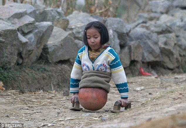 Cô bé chẳng còn cách nào khác ngoài việc thích nghi với cuộc sống mới. Qian được gắn một quả bóng rổ vào nửa người dưới để giúp cân bằng. Cô bé dùng một đôi tay cầm bằng gỗ để di chuyển.