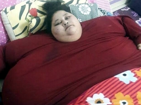Người phụ nữ nặng nhất thế giới được phẫu thuật giảm cân