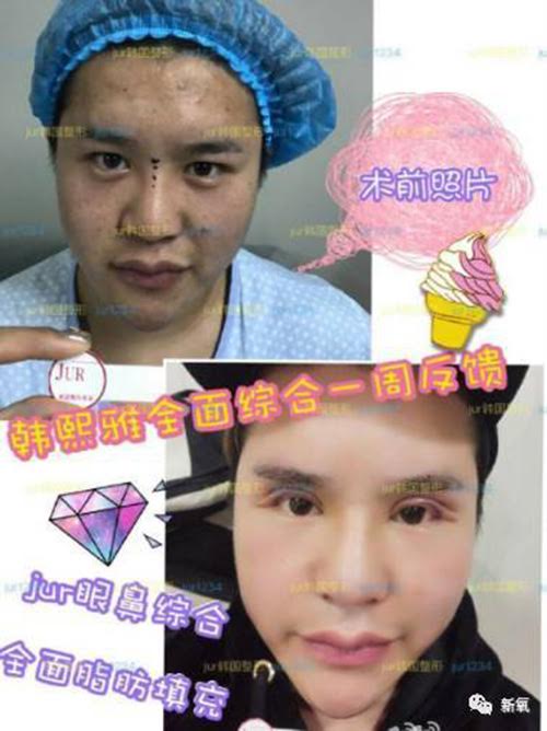 Hình ảnh so sánh Hàn Hy Nhã lúc trước khi phẫu thuật và sau khi thẩm mỹ thành công.