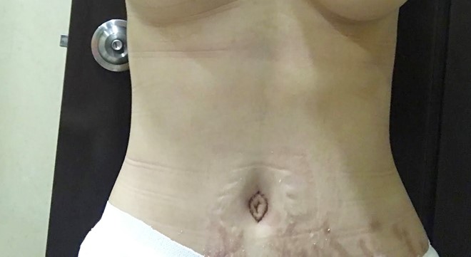 Vùng da bụng của Hồng Hạnh sau khi tiến hành phẫu thuật thẩm mỹ.