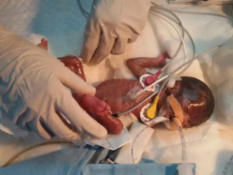 Sức sống kỳ diệu của em bé nhỏ nhất thế giới, nặng chưa đầy 0,5kg khi chào đời