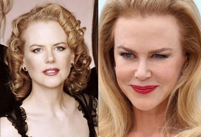 Trước khi đụng tới dao kéo Nicole Kidman đã sở hữu một nhan sắc xinh đẹp khiến nhiều người mê đắm, không hiểu sao cô lại quyết định PTTM khiến cho gương mặt mình trở nên cứng đờ như vậy.