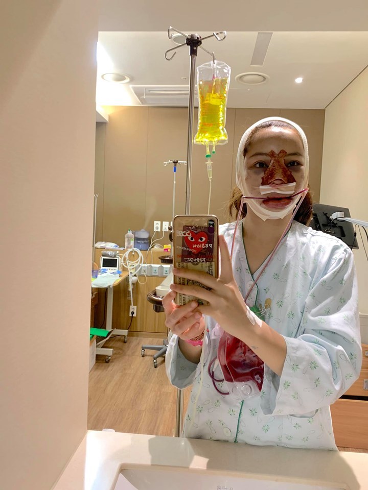  Lưu Đê Ly tự chụp lại gương mặt của mình sau khi phẫu thuật 6 điểm trên gương mặt. 