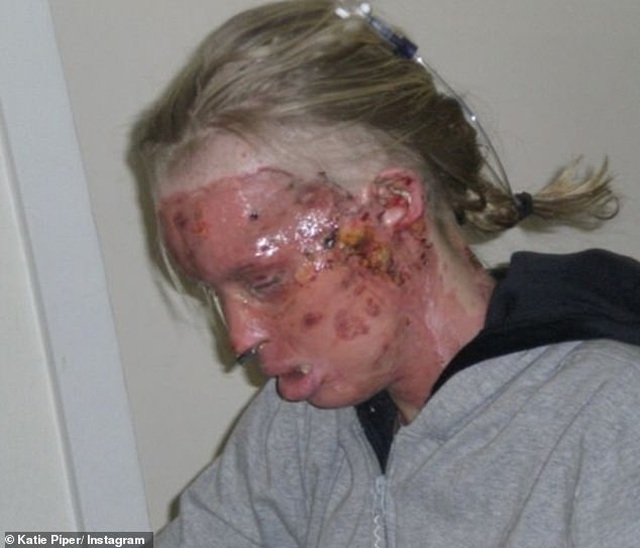 MC truyền hình Katie Piper chia sẻ gương mặt bị tàn phá vì axit.